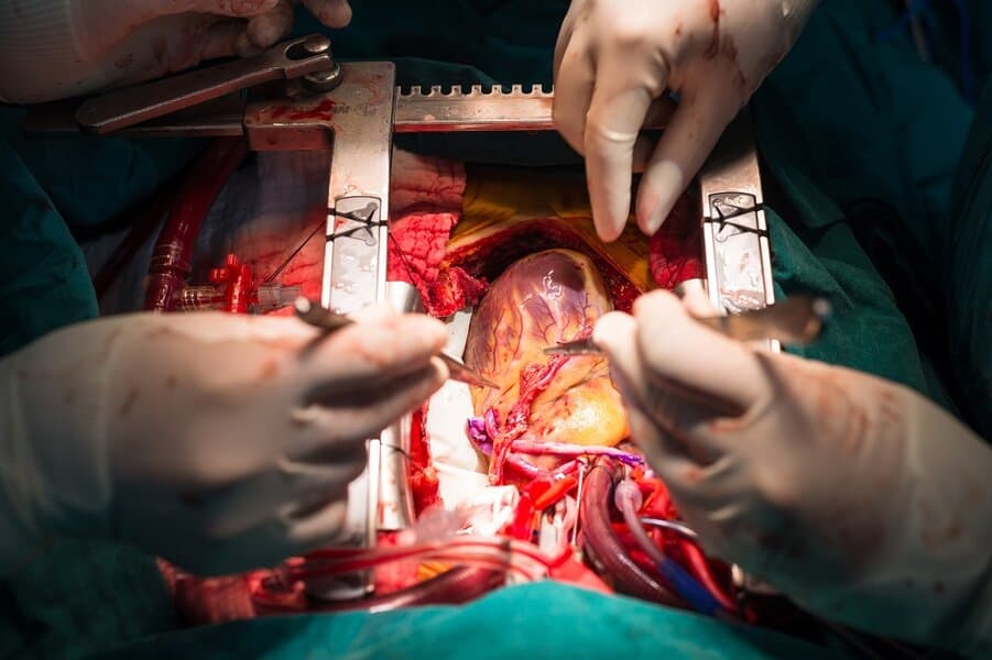 Coronary Artery Bypass Surgery