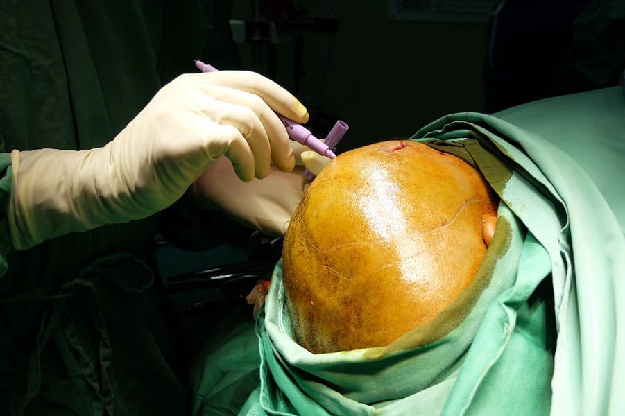 Craniectomy