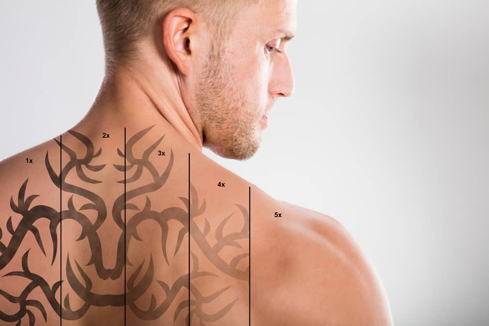 Laser Tattoo Removal On Shirtless Man's Back