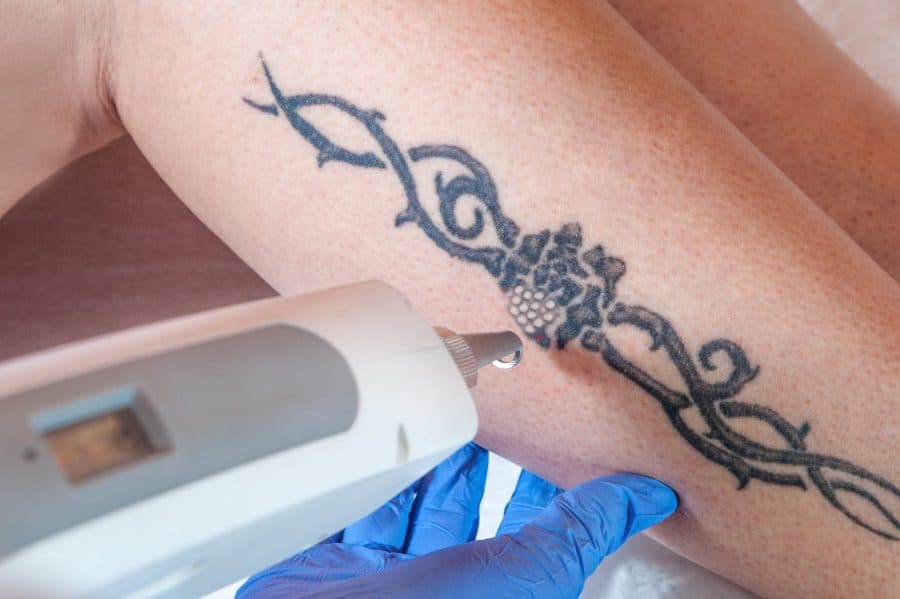 Poor Barbed Wire Tattoo Being Removed