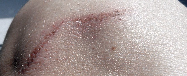 Can You Get A Tattoo Over A Scar