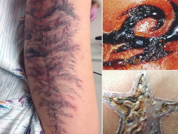Common Tattoo Infection Symptoms
