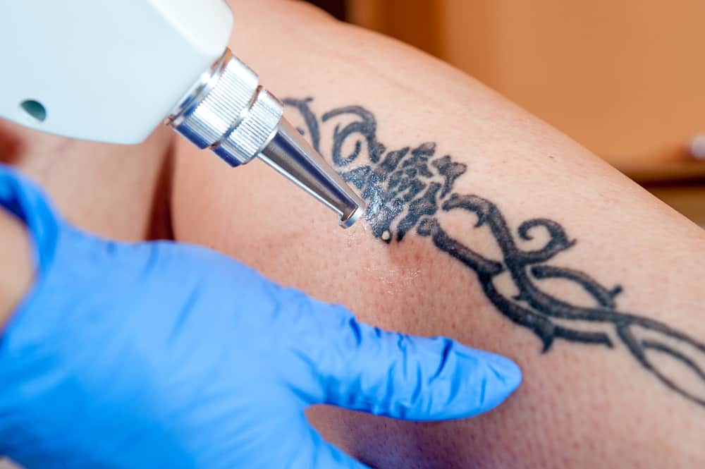 laser tattoo removal from leg