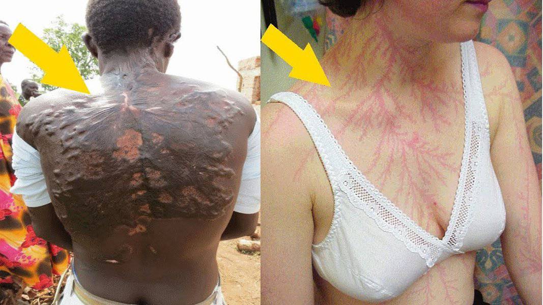 lightning strikes cases