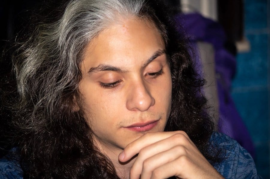 man with waardenburg syndrome