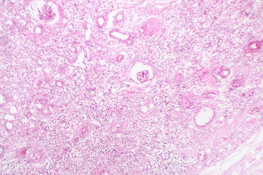 Contracted,Kidney,,Light,Micrograph,,Photo,Under,Microscope