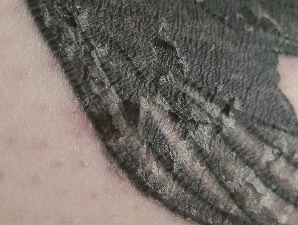 What To Do When Tattoo Is Peeling